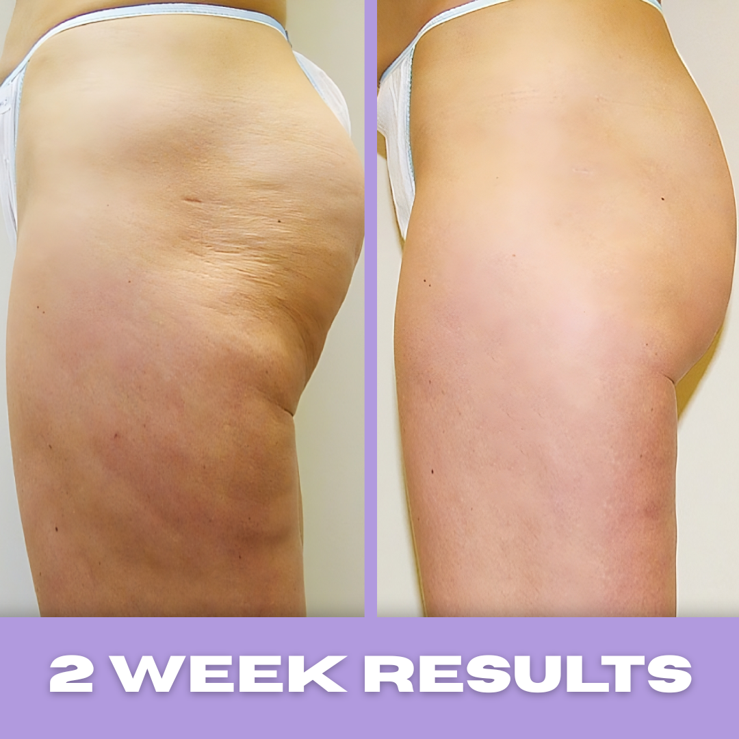 SkinPop Cellulite Massager