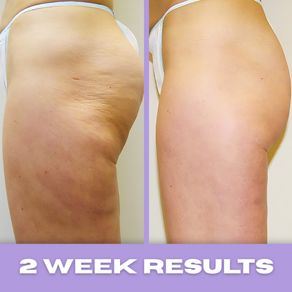 SkinPop Cellulite Massager