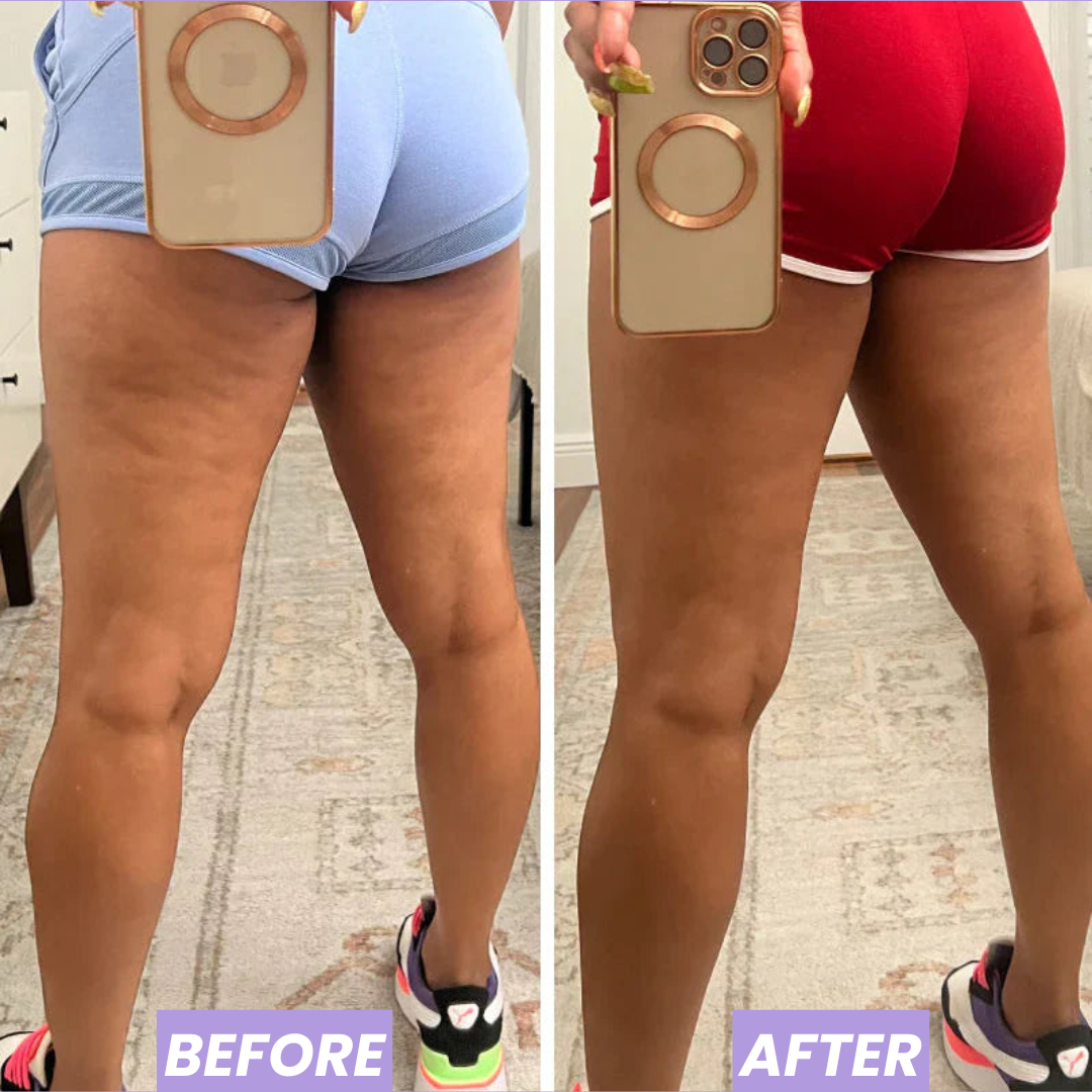 SkinPop Cellulite Massager